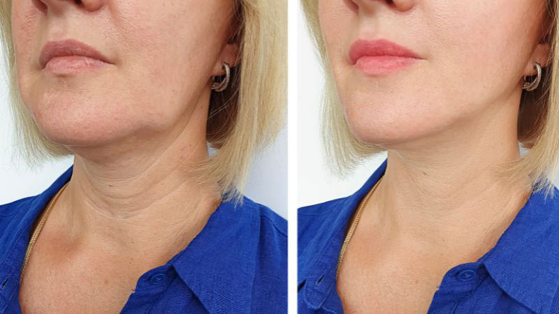 HGH change you face